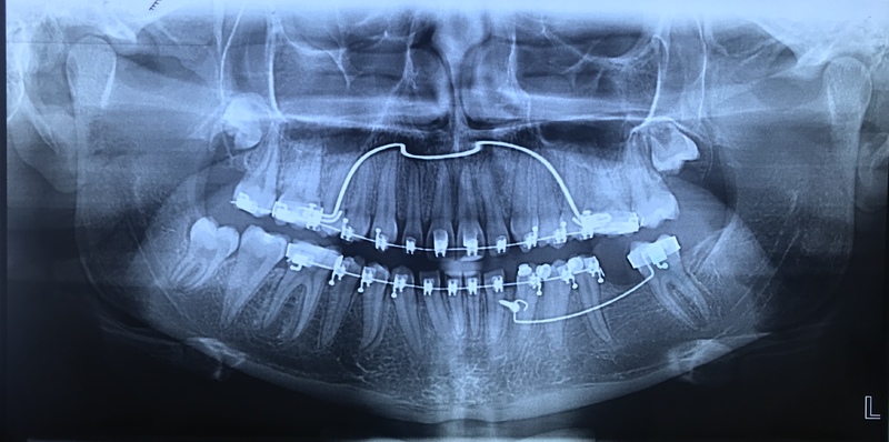Figura_3_Radiografia panoramica após colocaçao do mini implante.jpg